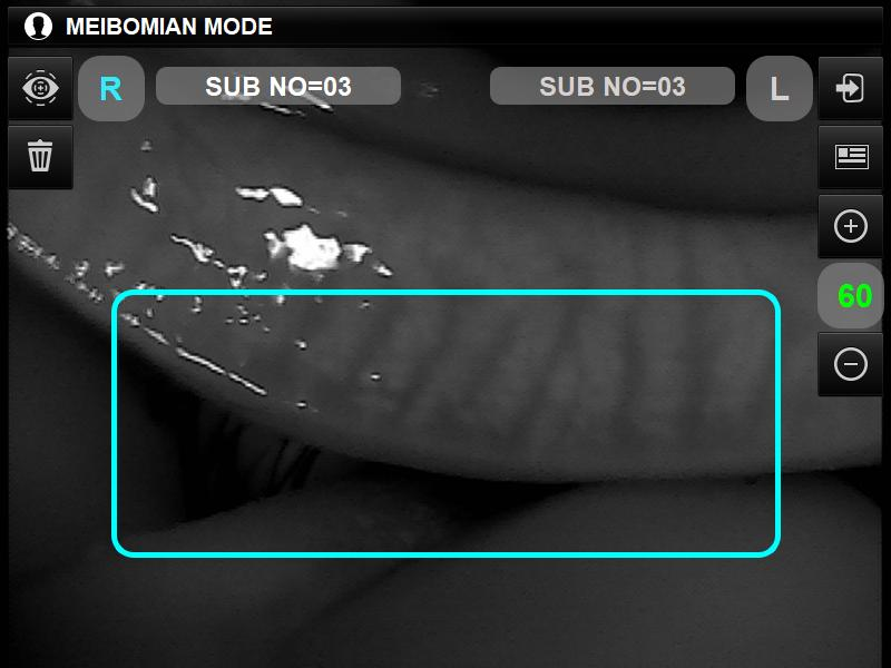 visionmed_meibomian_mode.png visionmed_meibomian_mode.png